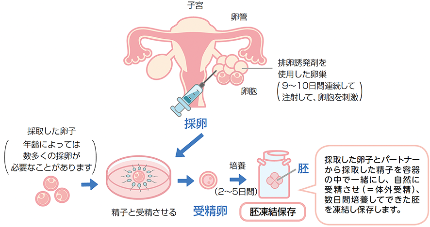 胚（受精卵）凍結保存の採取の方法：排卵誘発剤を使用した卵巣（9〜10日間連続して注射して、卵胞を刺激）から採卵。採取した卵子（年齢によっては数多くの採卵が必要なことがあります）→採取した卵子とパートナーから採取した精子を容器の中で一緒にし、自然に受精させ（＝体外受精）、数日間培養してできた胚を凍結し保存します。